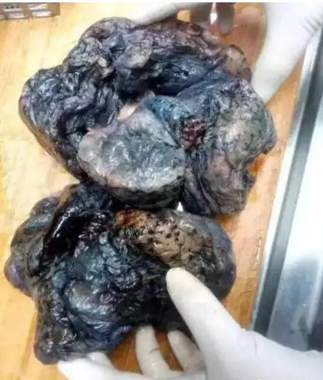 门诊来了位患者,60多岁的他就有着40多年的烟龄,他是肺癌,就在不久前