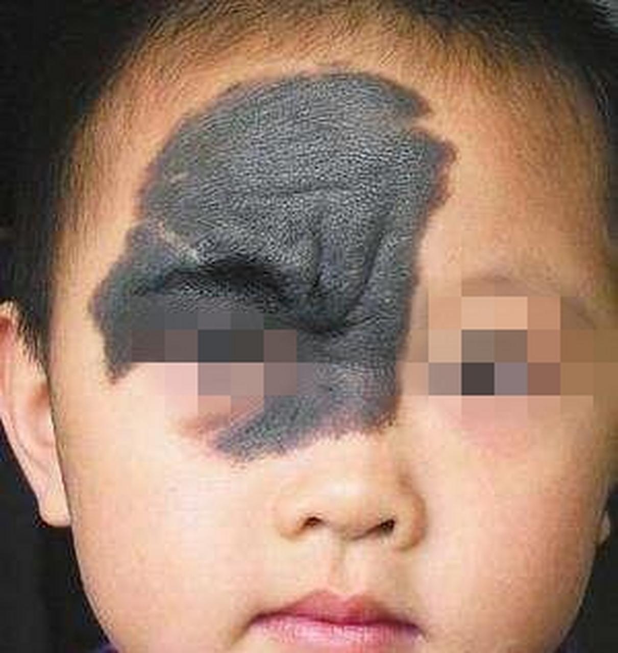 这位小患者额头,眼睛被大面积兽皮痣覆盖,非常影响美观,对眼睛功能也