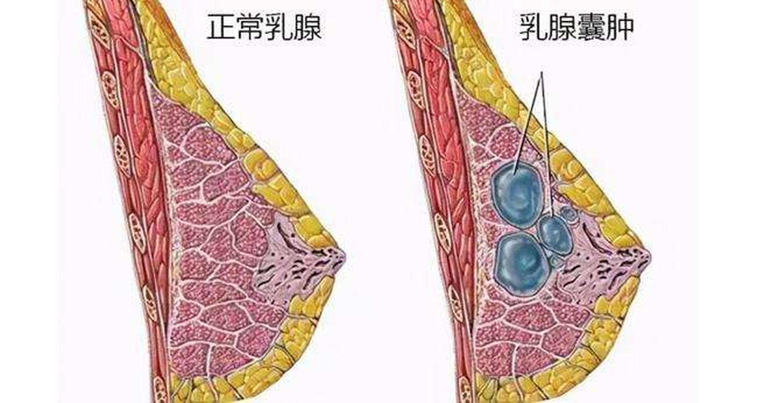 乳腺囊肿跟结节哪个严重 乳腺囊肿和乳腺结节两者相比,乳腺结节要更