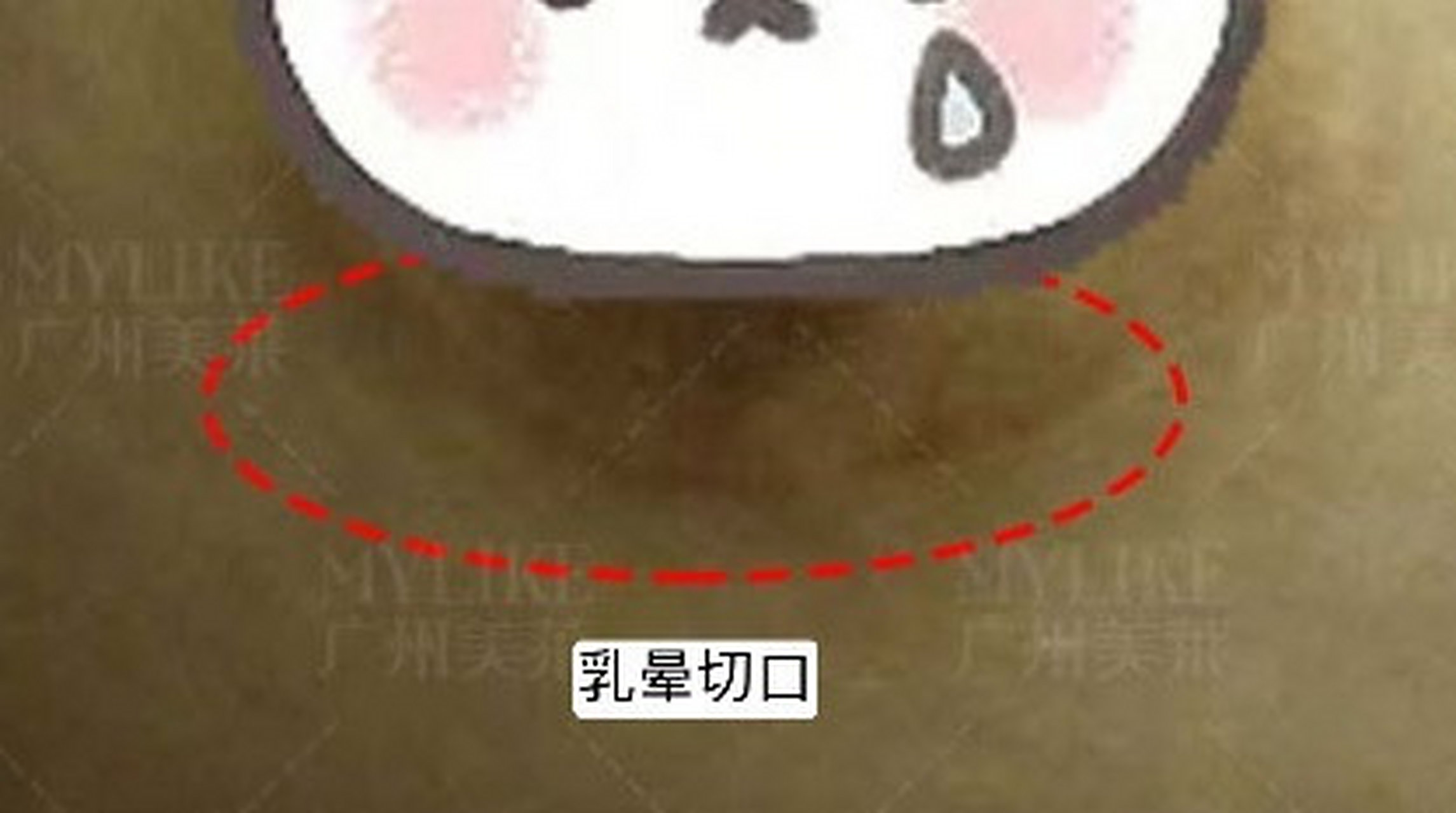 1,腋下切口:伤口隐蔽,恢复后基本看不出来,同时避免对乳腺损伤,不