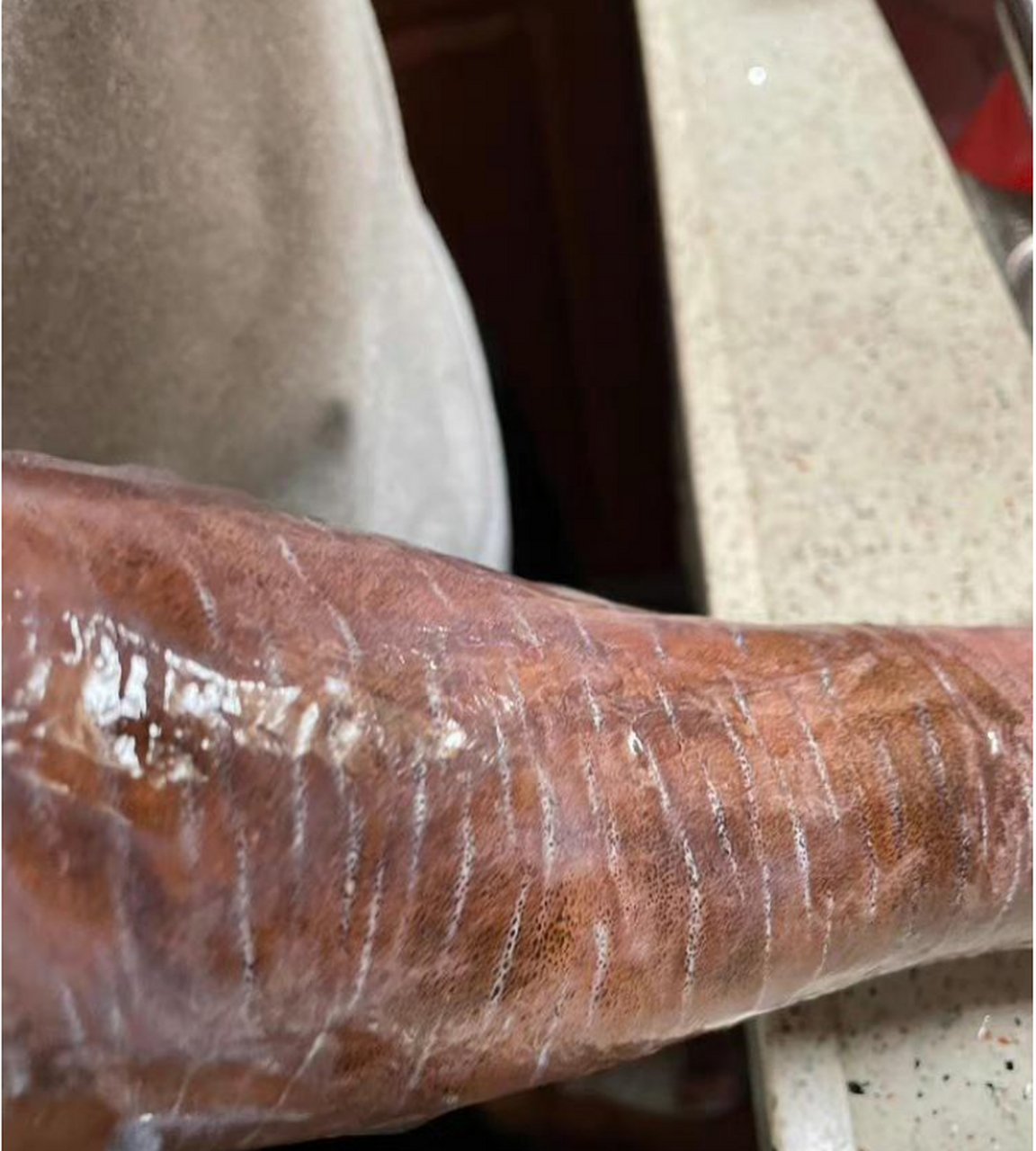 这中类型的手臂受伤应该挂什么科啊