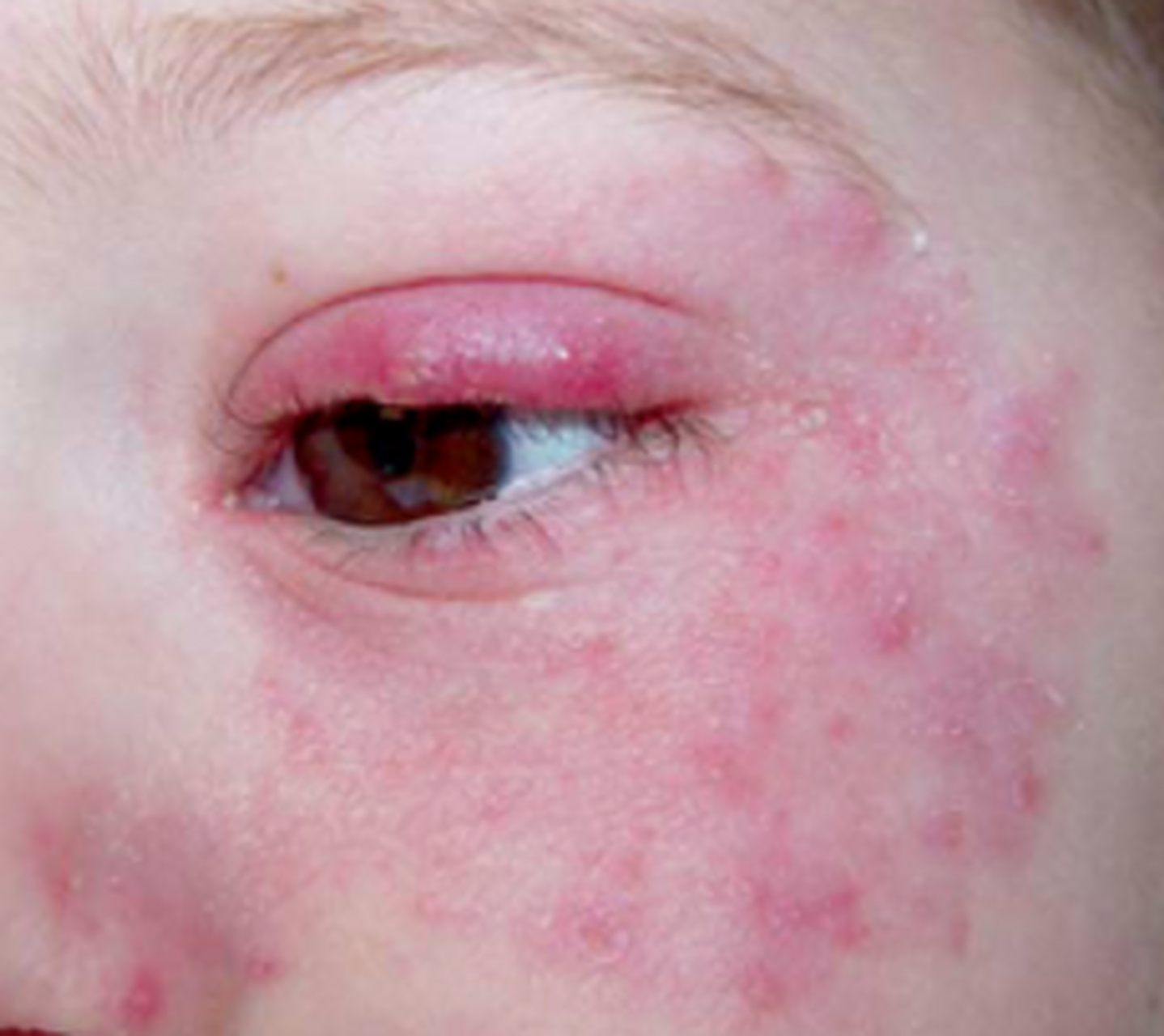 儿童皮肤癣菌感染的常见类型包括头癣,体股癣,面癣,手足癣等,其