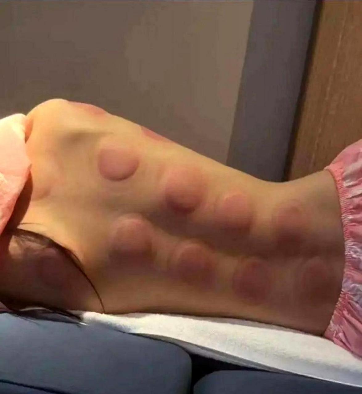 拔罐后,身体会呈现出图二的状态.