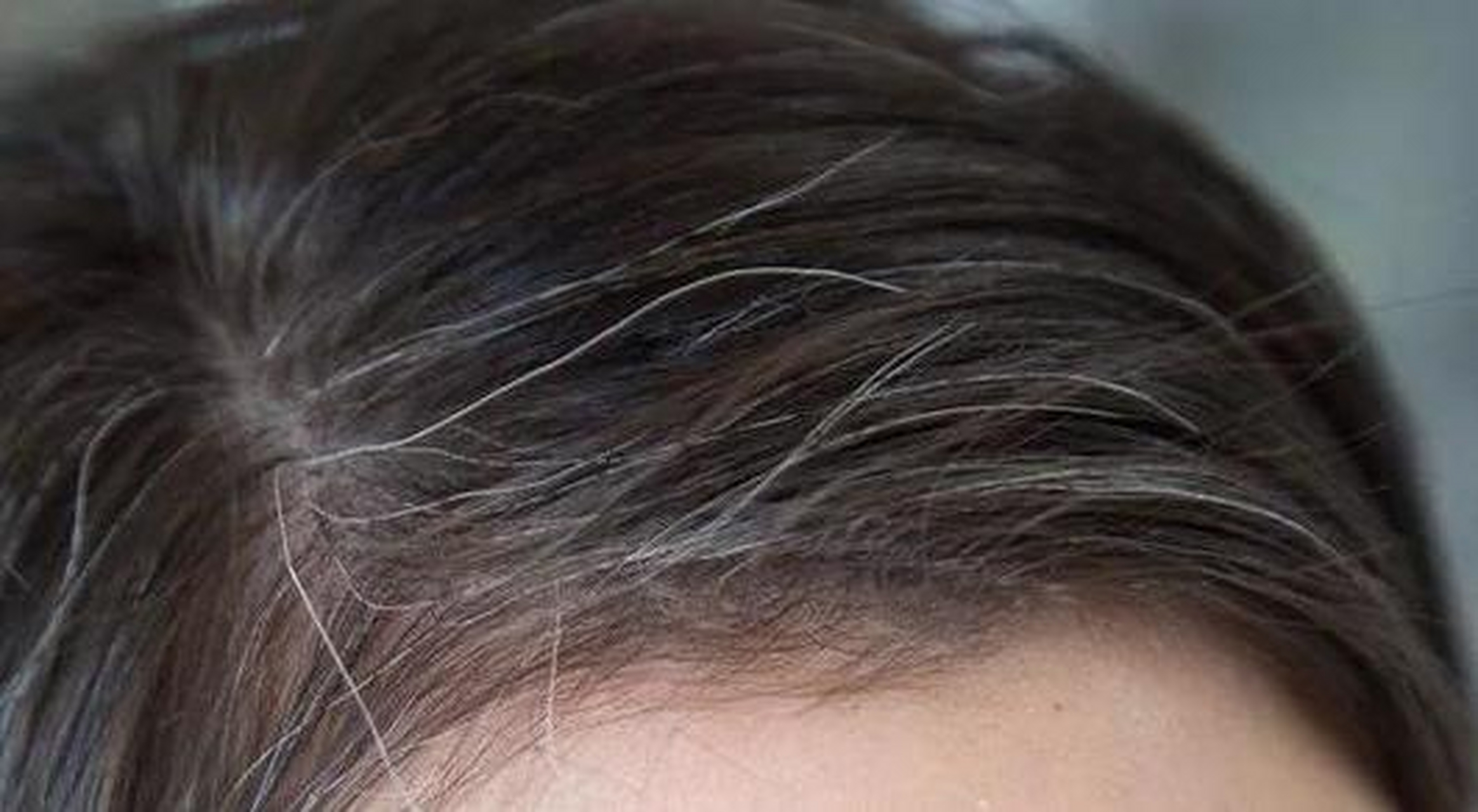 白头发一般可以分为生理性白发和病理性白发.