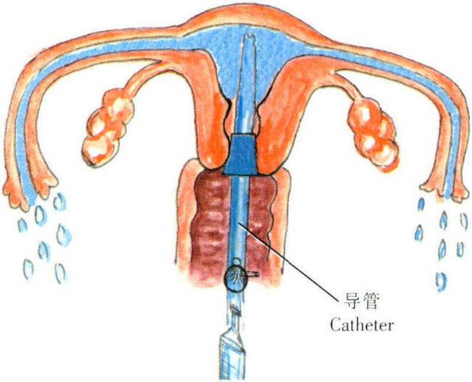 通水指輸卵管通液,女性在輸卵管通液的當月一般不建議懷孕,建議3個月