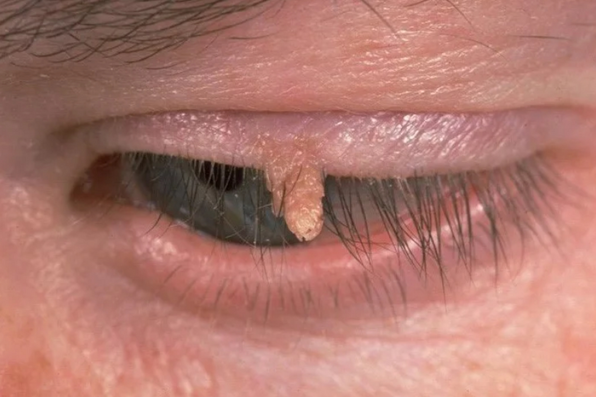 丝状疣会传染成为尖锐湿疣吗?