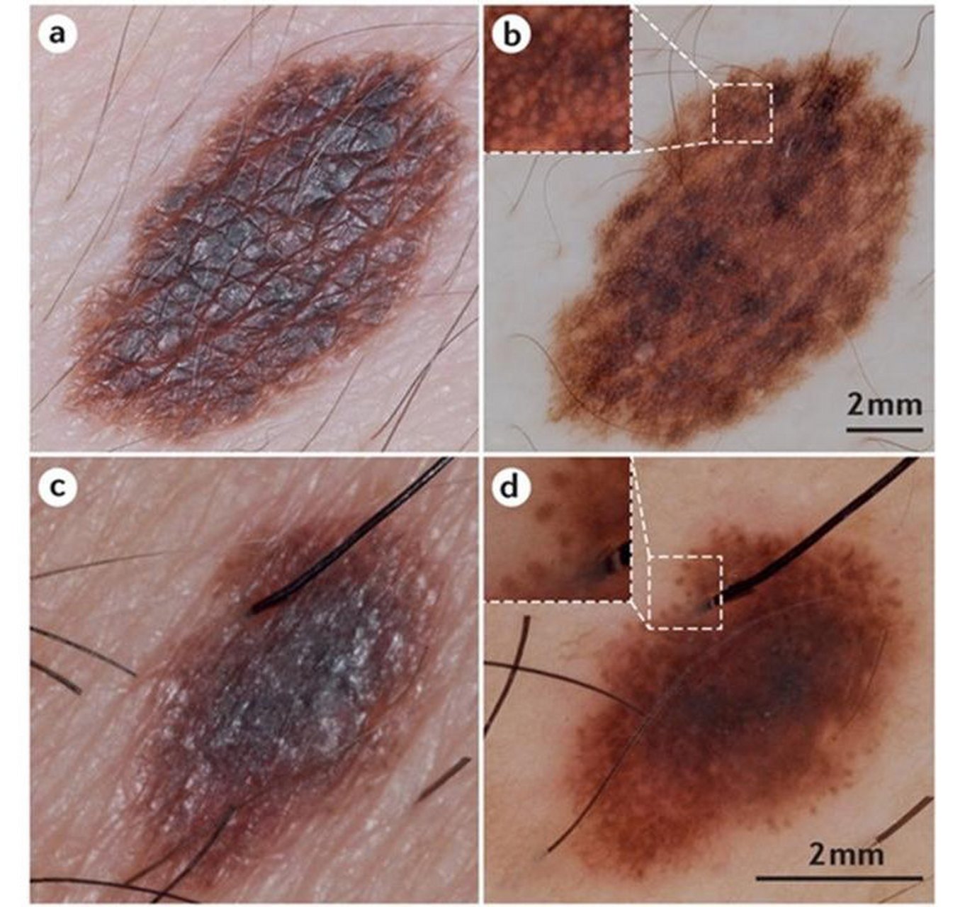 【身上长了色素痣,有必要切除吗?