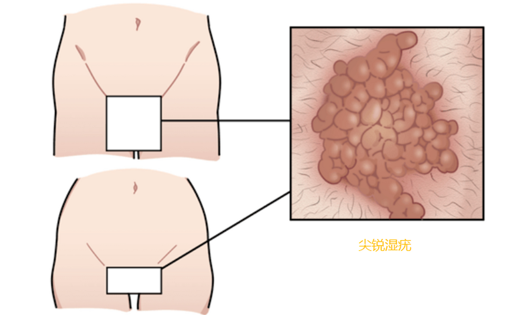 尖锐湿尤潜伏期图片