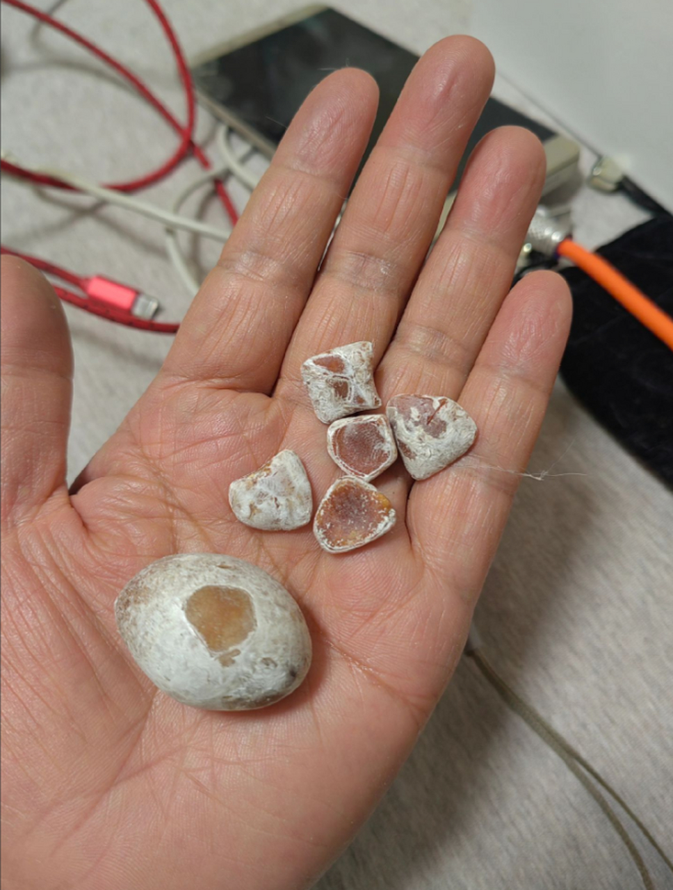 胆结石放了三年成了这个颜色了