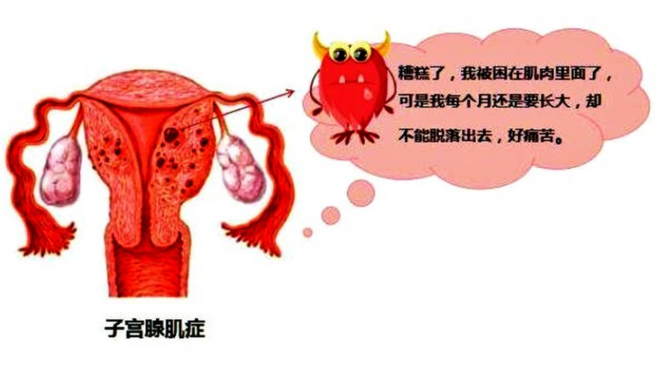 虽然子宫腺肌症发病率很高,临床上几乎很多女性会患上这种病,但因其