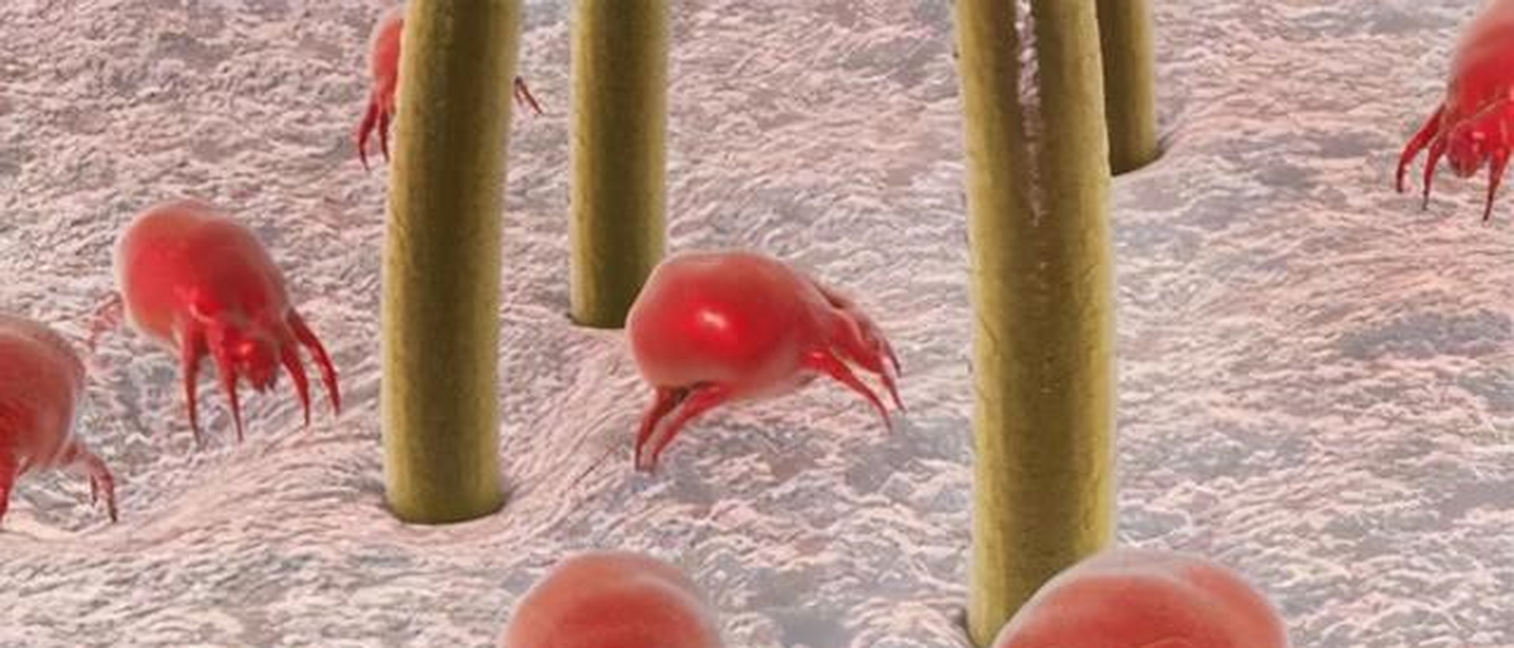 过不了多久,头皮又换油了,是螨虫刺激皮脂腺引起的,油脂越多的地方