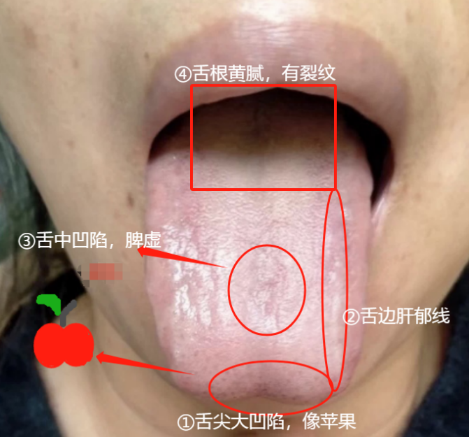 舌尖凹陷严重,犹如苹果,这种舌象的患者,睡眠对于其