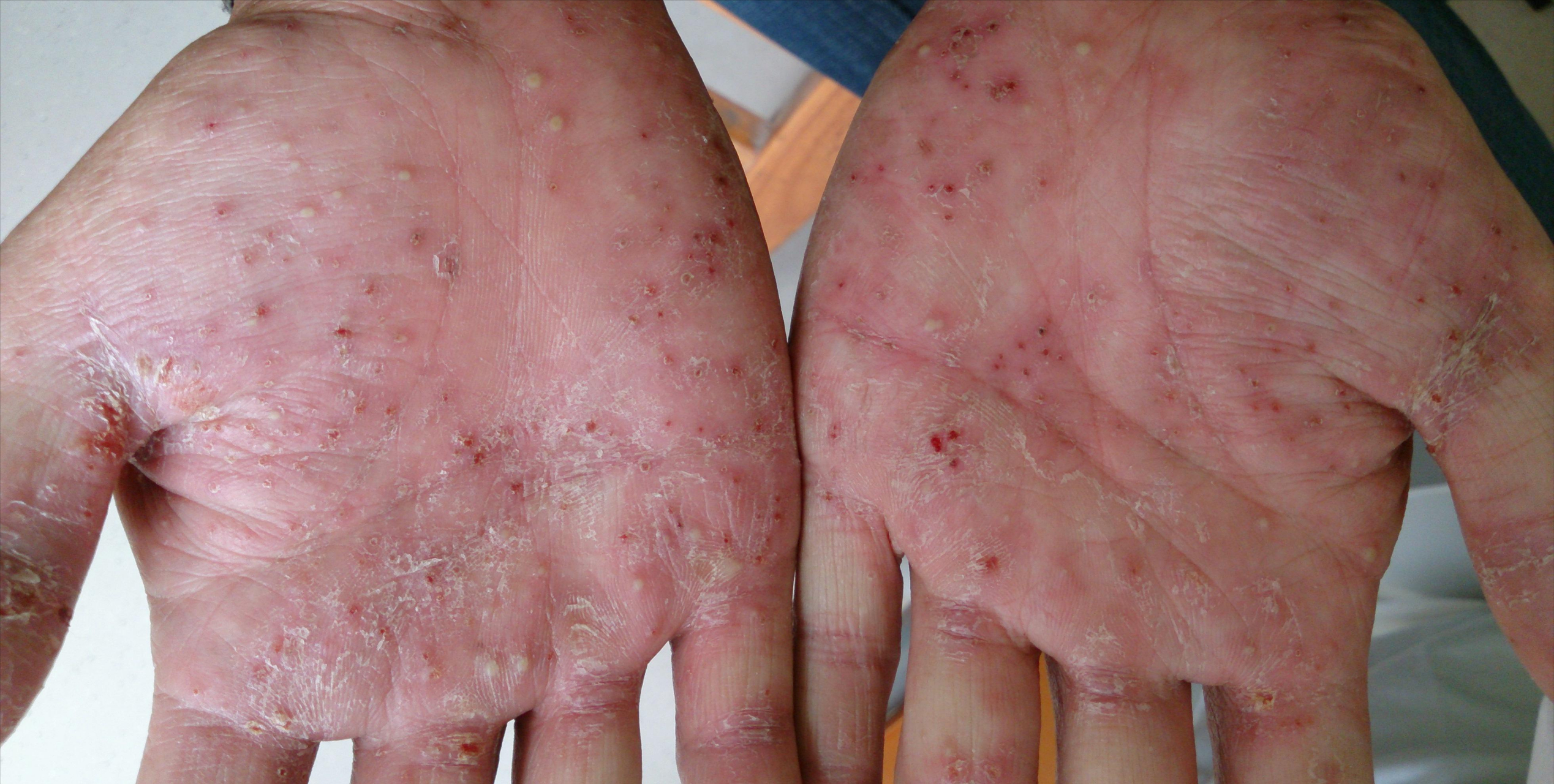 其实得了掌跖脓疱病,真的很折磨人!