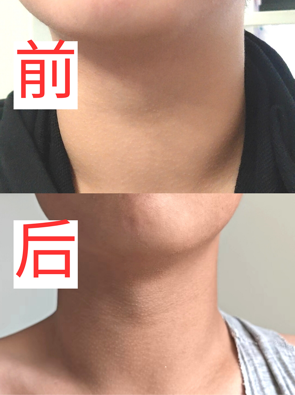 13岁男孩桥本甲减脖子肿大,调理三个月前后对比!