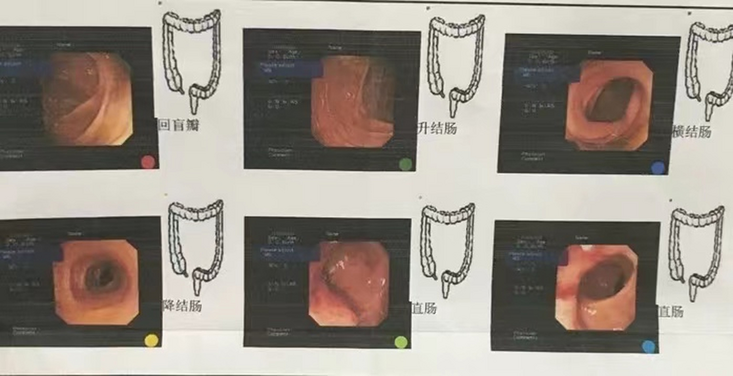 65岁的老王,一个星期前,经常胃疼,排出的大便十分的细,而且比较难排出