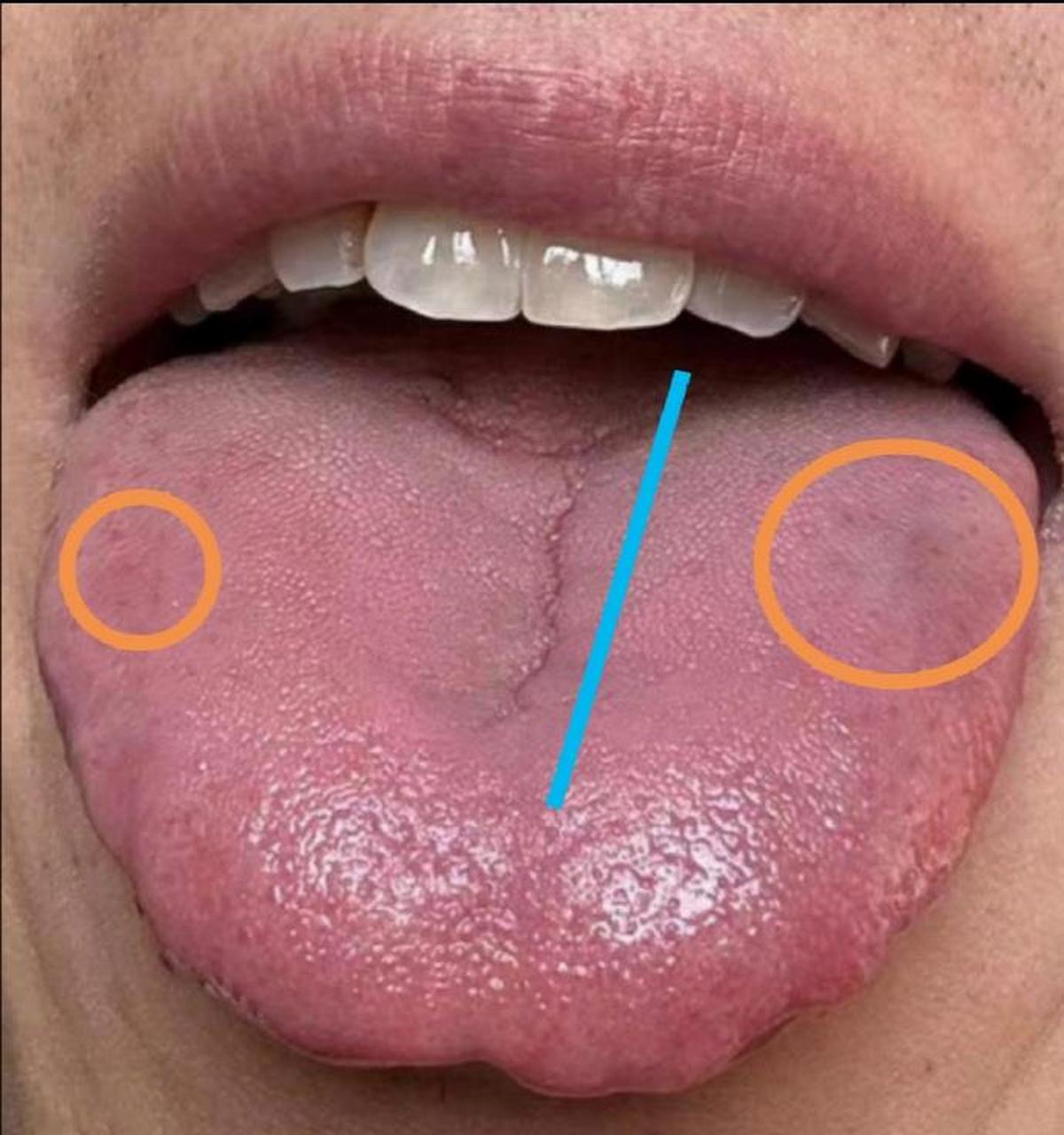 黄色圆圈代表淤血点,肝郁了气血瘀滞舌头中间有裂纹,代表脾胃虚弱