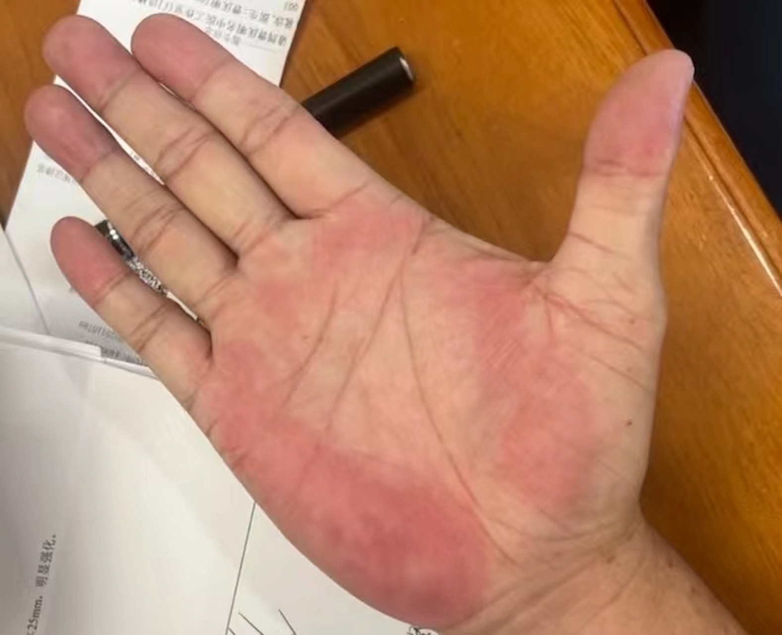 给大家看一个图片,图中这就是肝掌,很明显的就能看出,手掌的大小鱼际