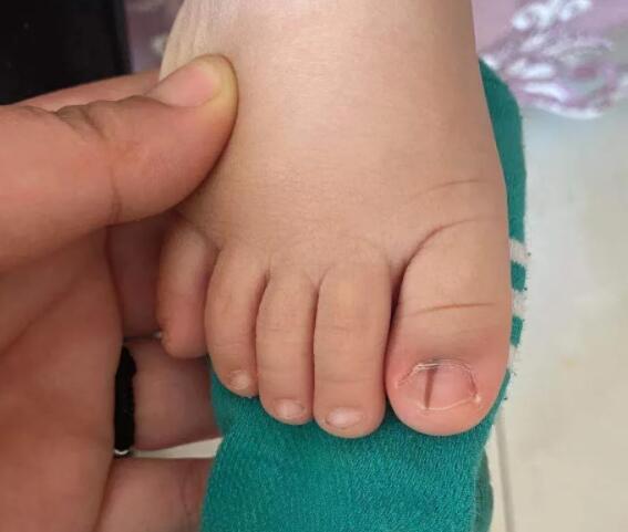 三岁小宝宝最近发现指甲中间长了一条线