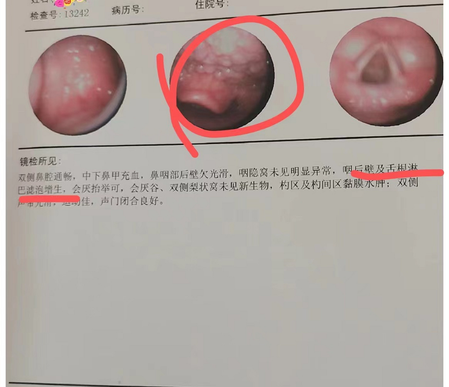 第一,引起滤泡型咽炎的原因是什么?