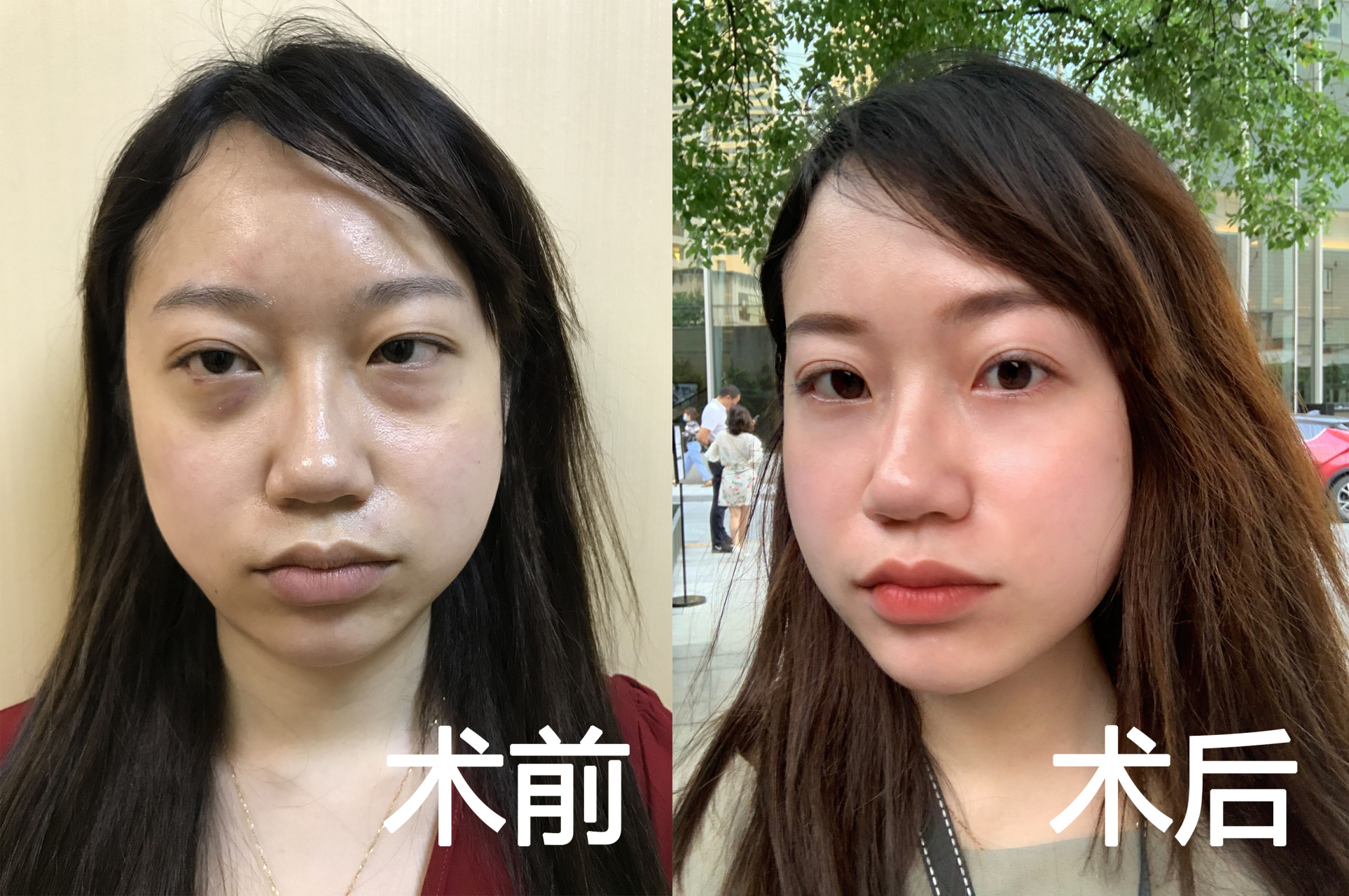 这位女生是遗传的脂肪型眼袋,十几年的用过眼膜眼霜都没有改善,杂加