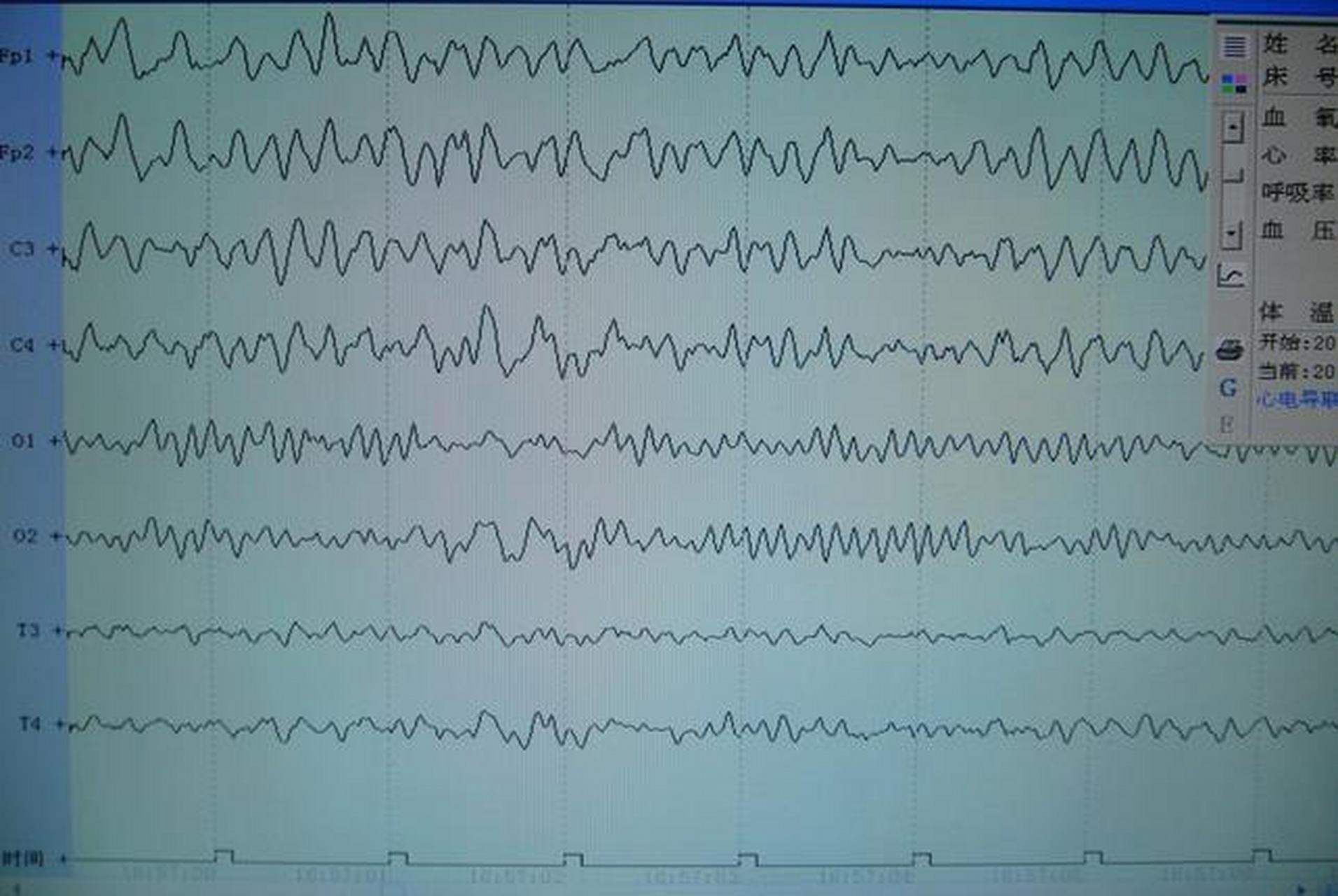 脑电图正常但是抽搐图片