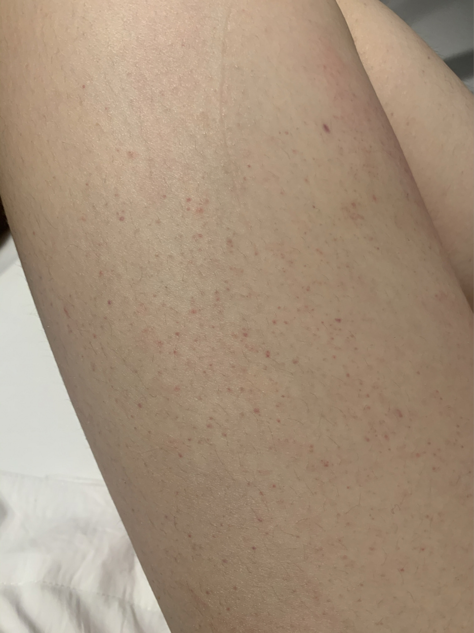 身上出现这种小红点,好害怕  请问你们都知道这是什么吗,后天星期一想