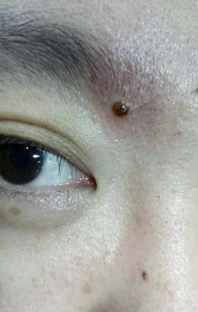 但是,我们该如何区分黑色素痣的良恶性呢?下面我来为你详细解释一下.