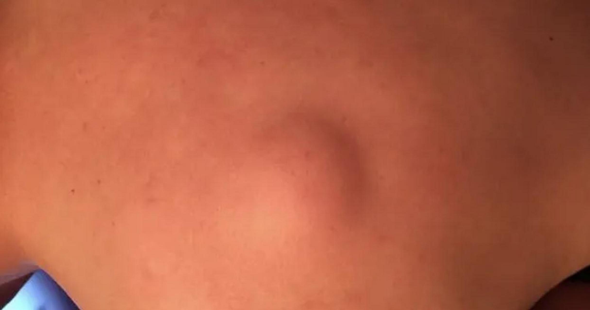 我老公公今年50岁,背上长了个大疙瘩,不痛不痒,以为是脂肪瘤,也没在意