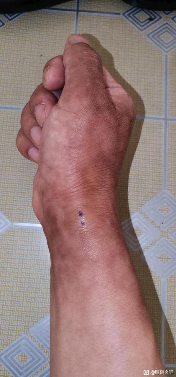 针刀治疗手腕腱鞘炎 2 #狭窄性腱鞘炎# #疾病治疗经验# #健康经验笔记