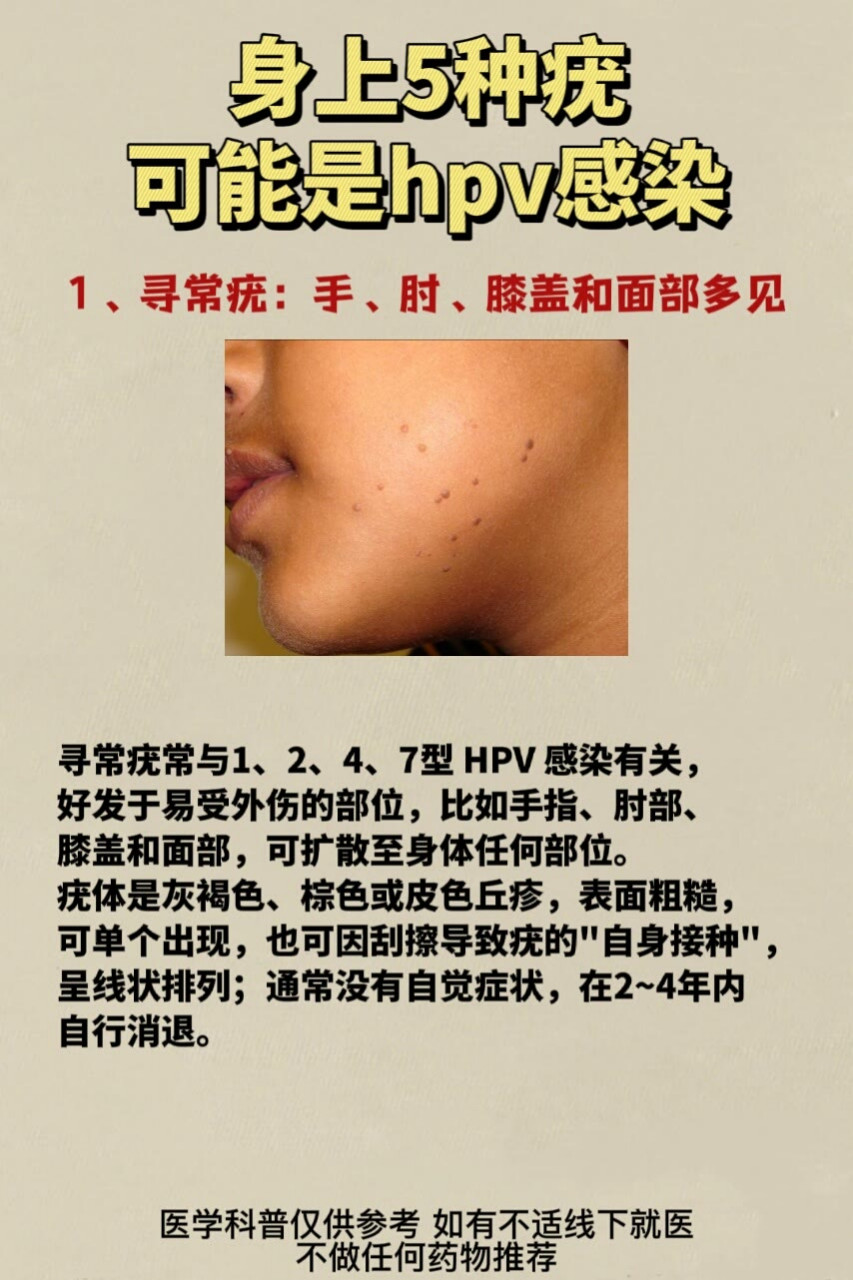 女性朋友注意了,身上有这5种疣,很有可能感染hpv了#妇科病# #hpv