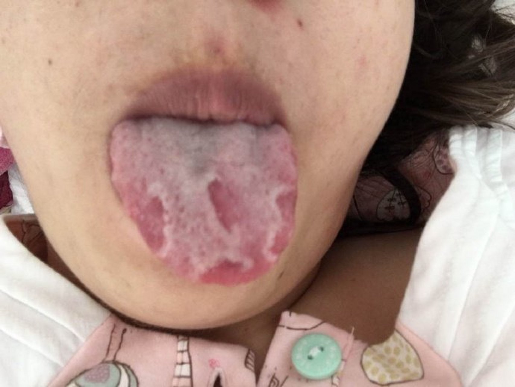 剥苔舌,地图舌,可不仅仅只有阴虚  这是一个溃结患者的舌苔,前两张是