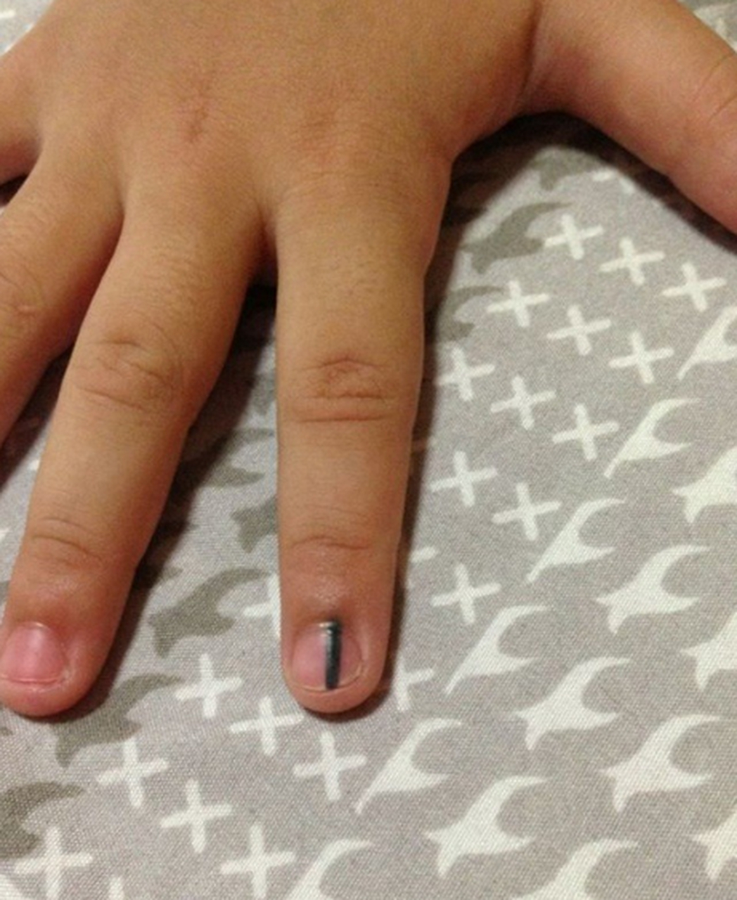 指甲长出黑线是怎么回事?