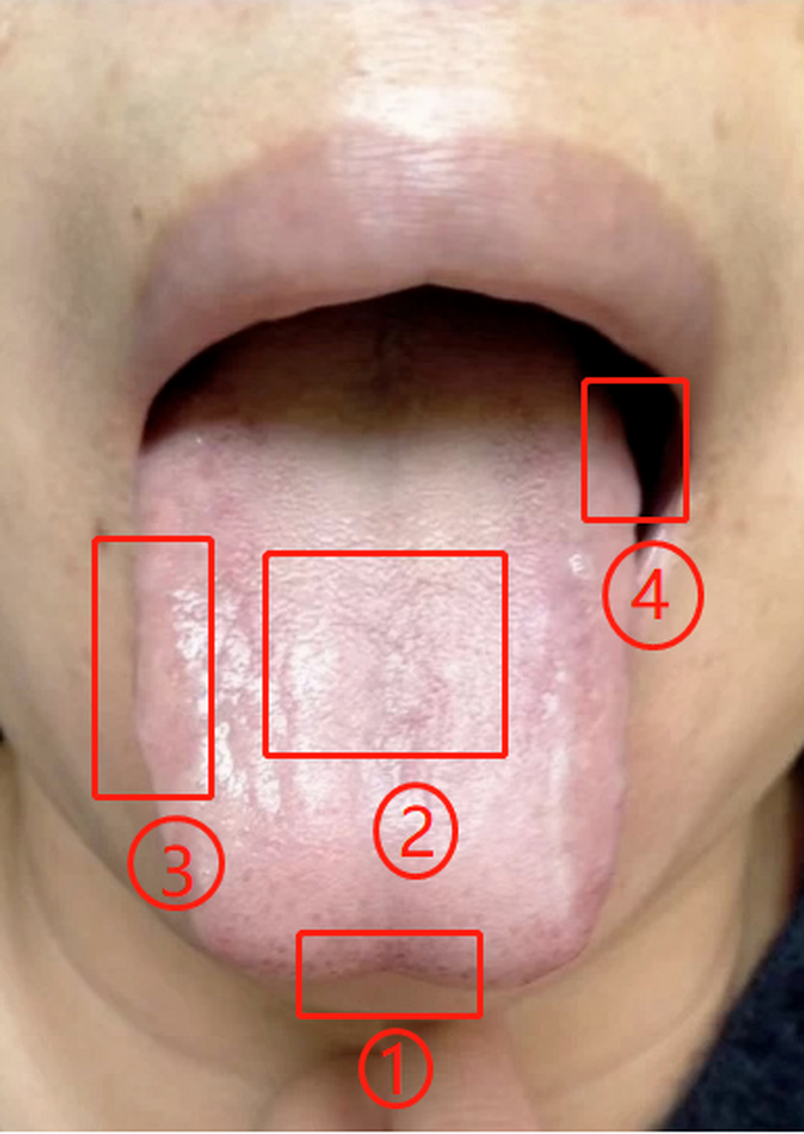 妇科病严重的舌头图片图片