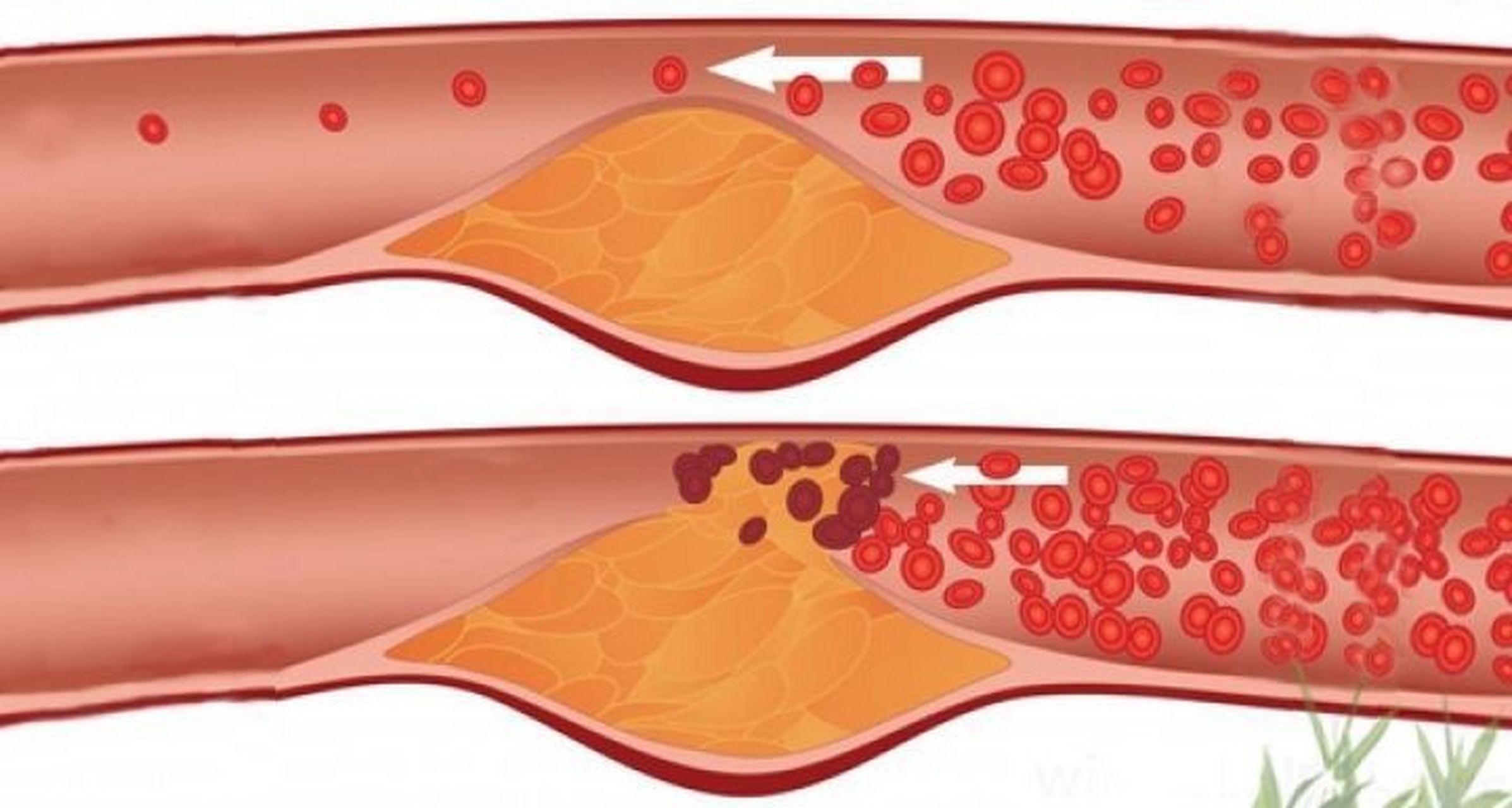 得了冠心病就一定要放支架吗?