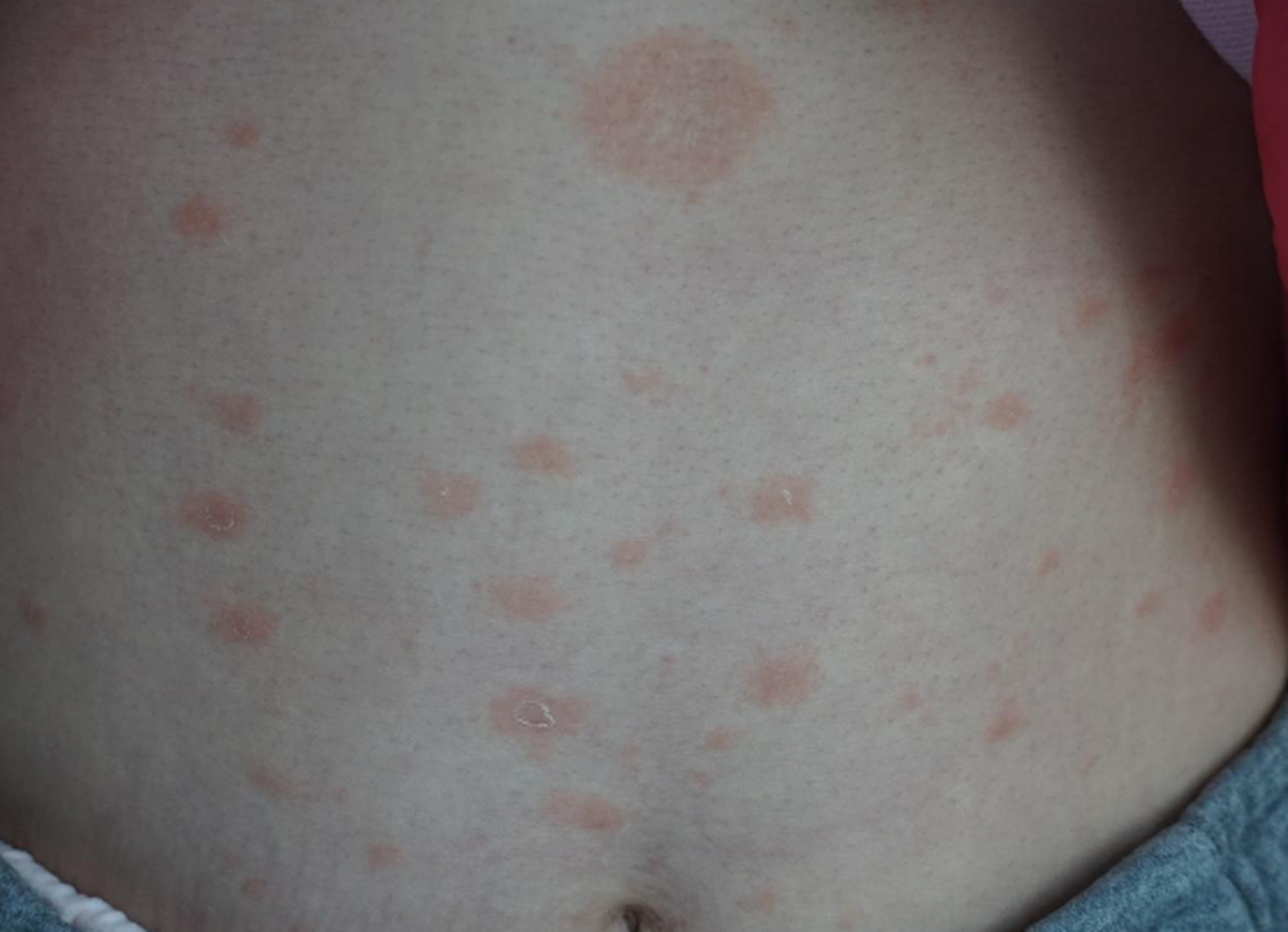 玫瑰糠疹,是说皮疹像玫瑰花一样的红色,实际上颜色不是那么鲜红;有