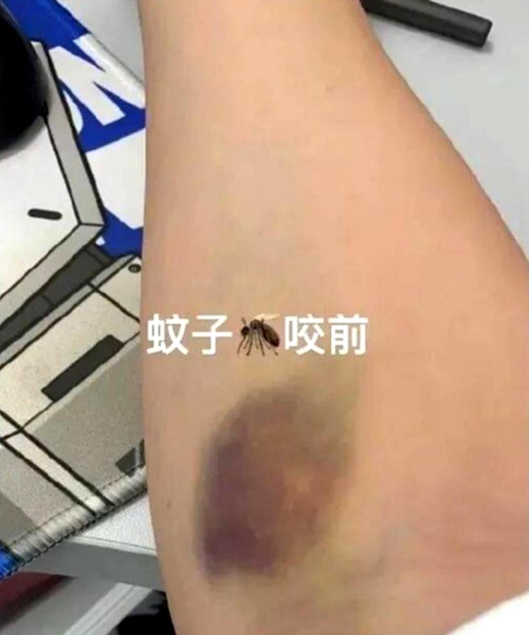 蚊子也能吸取淤血?