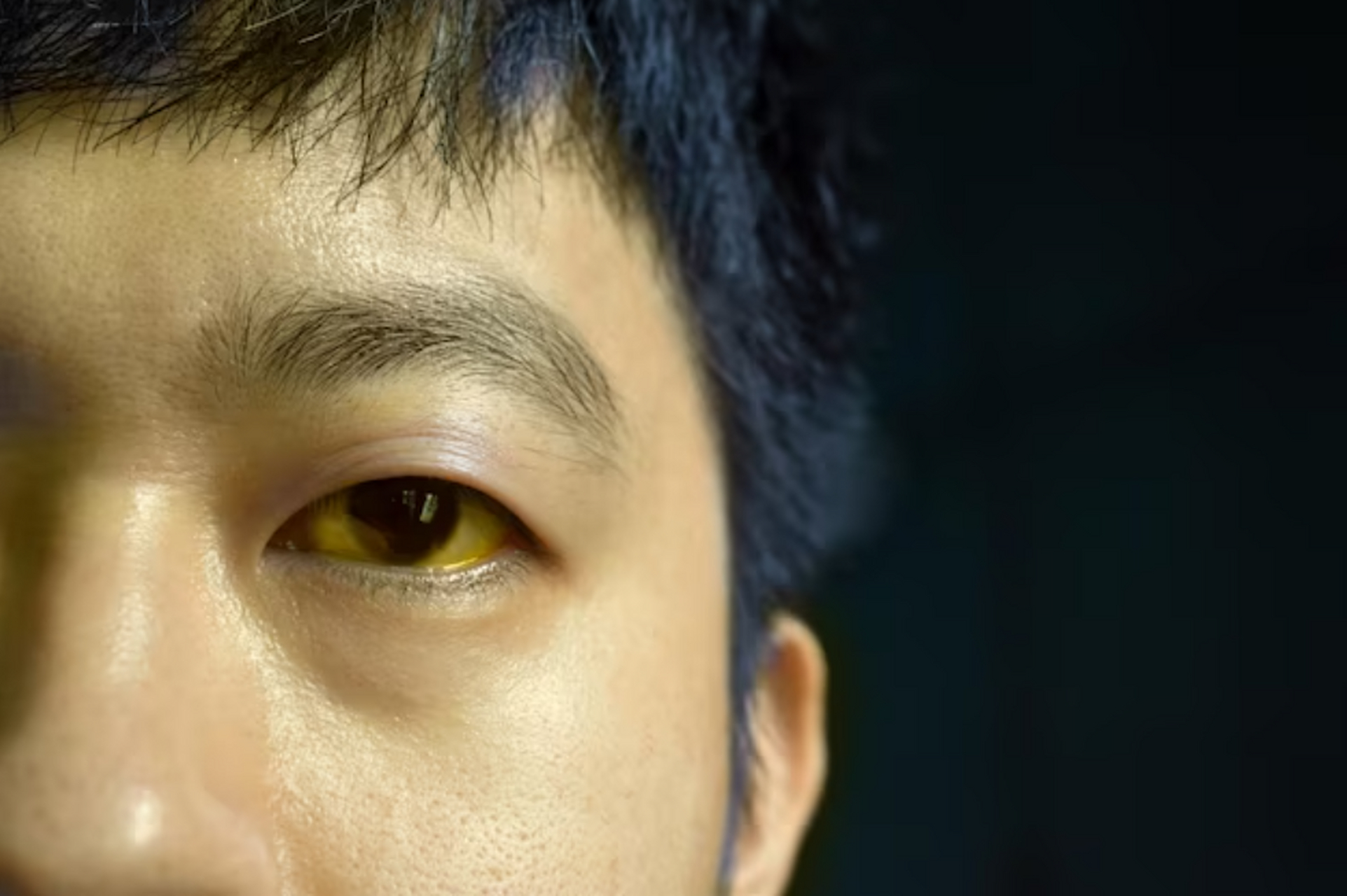 眼白变黄,由于肝脏功能异常造成的胆管阻塞,炎症等问题,导致体内