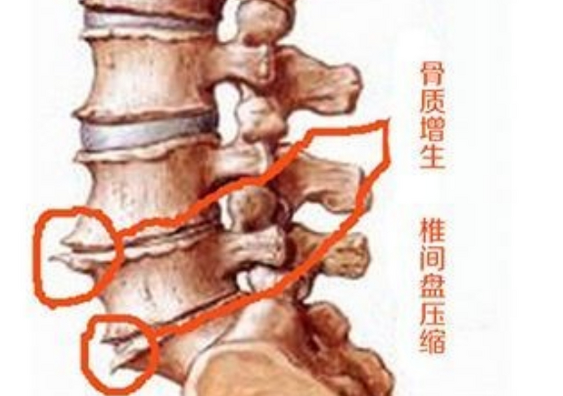 骨质增生如何治疗?