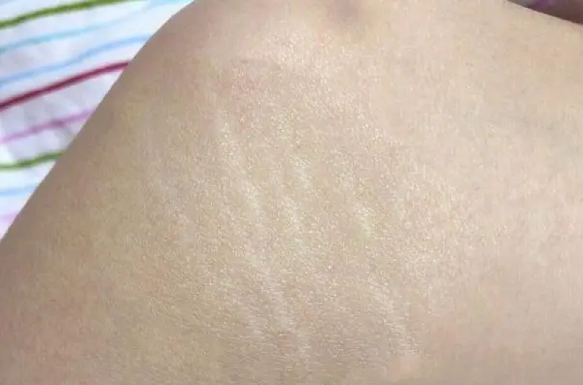 24岁男子,订婚后发现未婚妻肚子上有"妊娠纹",男子大怒,未婚妻解释