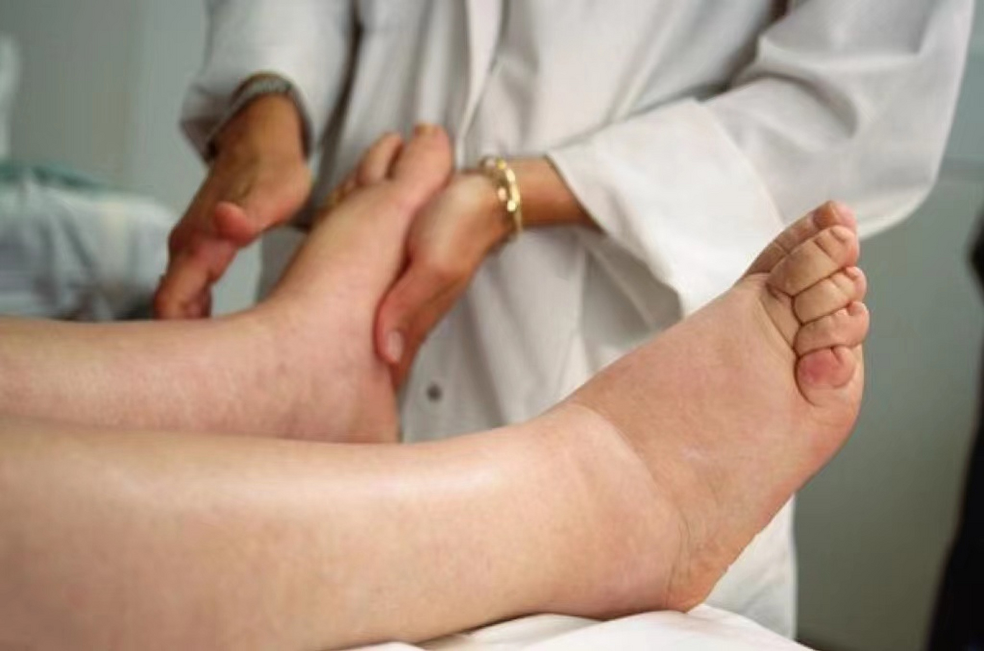 当双下肢出现无法消除的浮肿,你可以用手指按压脚踝或小腿,手指霜开