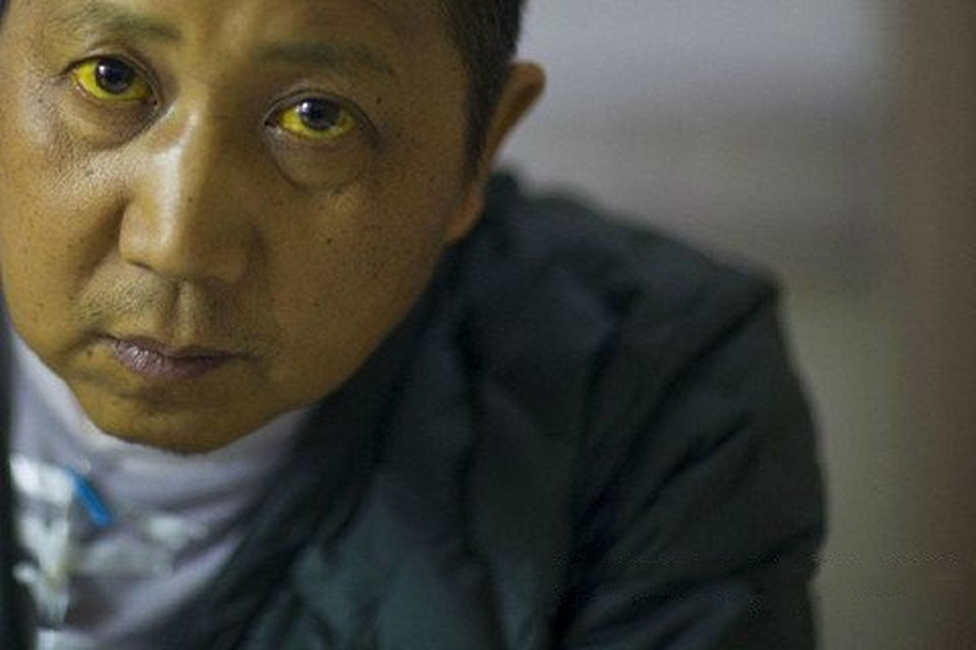 黄疸的中医辩证与治疗 黄疸中医辨证可分为阳黄,阴黄,急黄. 1.