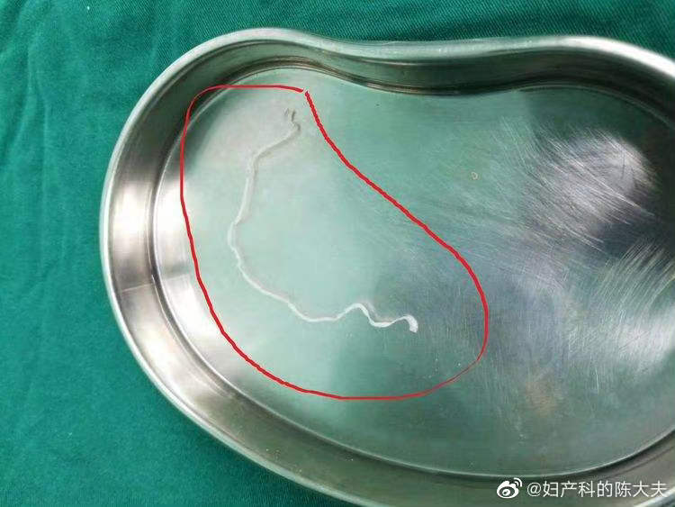 新闻里的女子感染的是裂头蚴,是曼氏迭宫绦虫的幼虫,和前几天我科普