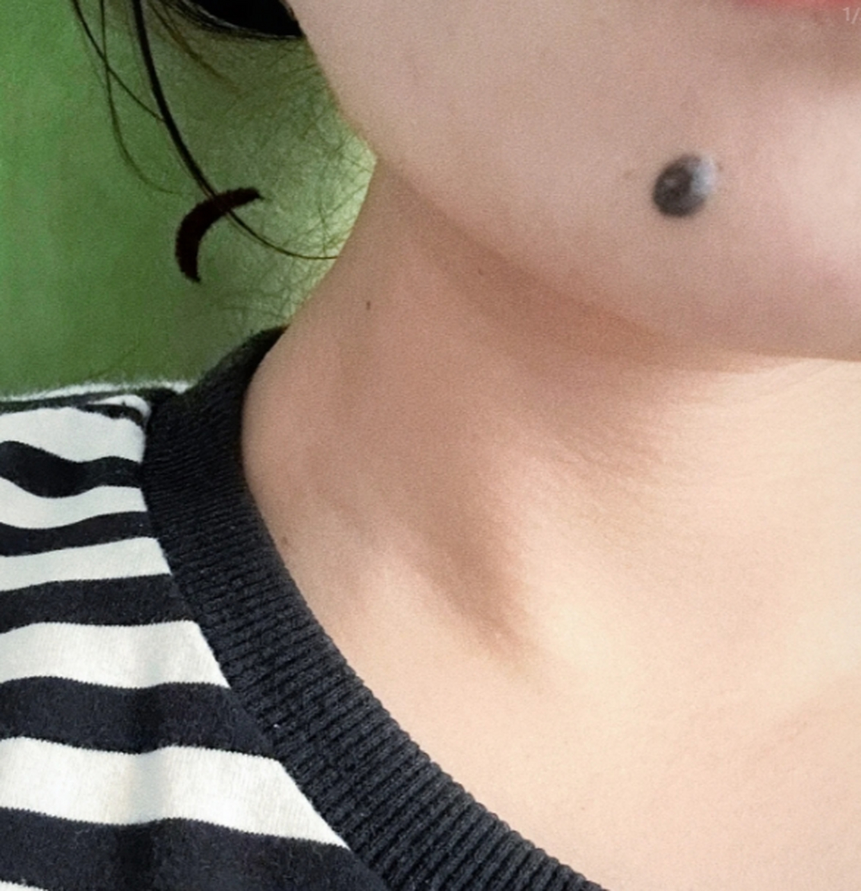 医美科普挑战赛#  凸起的黑痣通常被称为皮肤瘤或黑色素瘤,是一种