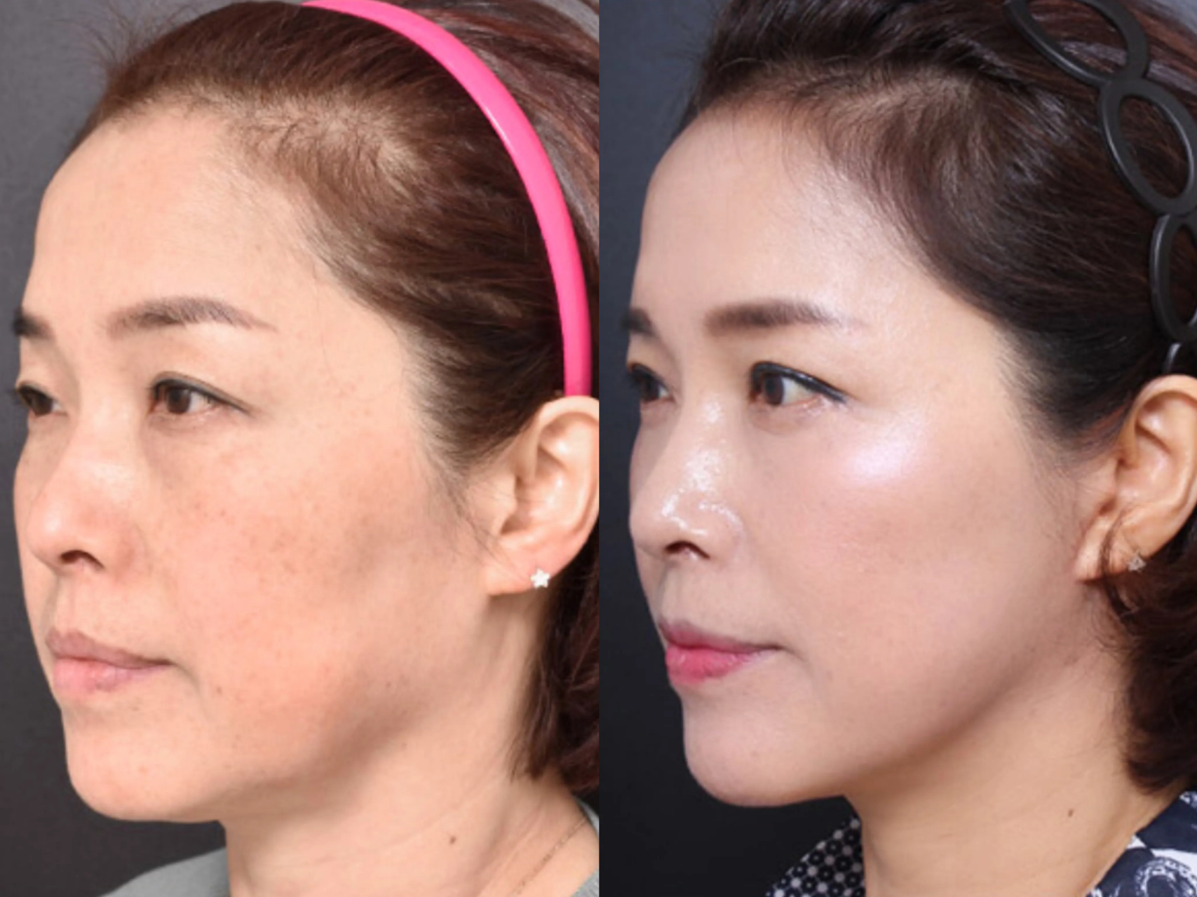 45岁去北京做了"分层定点拉皮",第2天开始肿胀,第6天我照镜子,恍然