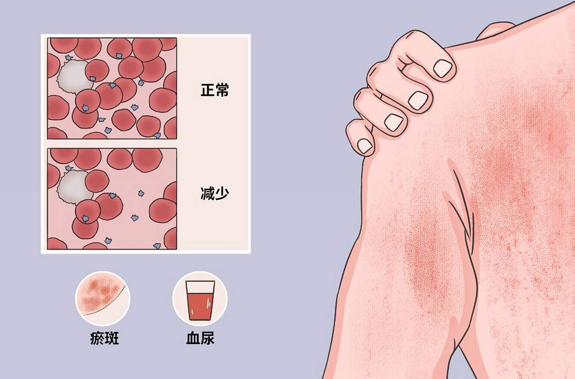 再生障碍性贫血简称再障,是一组由多种病因所致的骨髓造血功能衰竭性