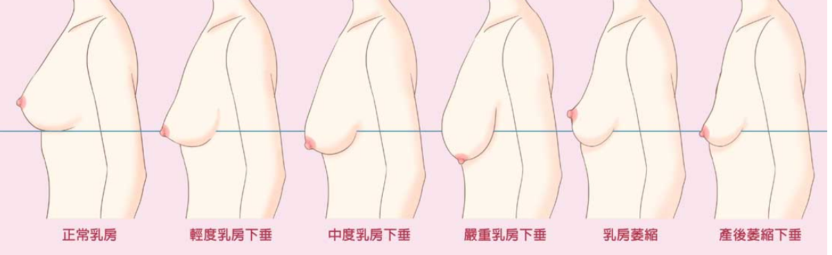 乳房下垂分度图片