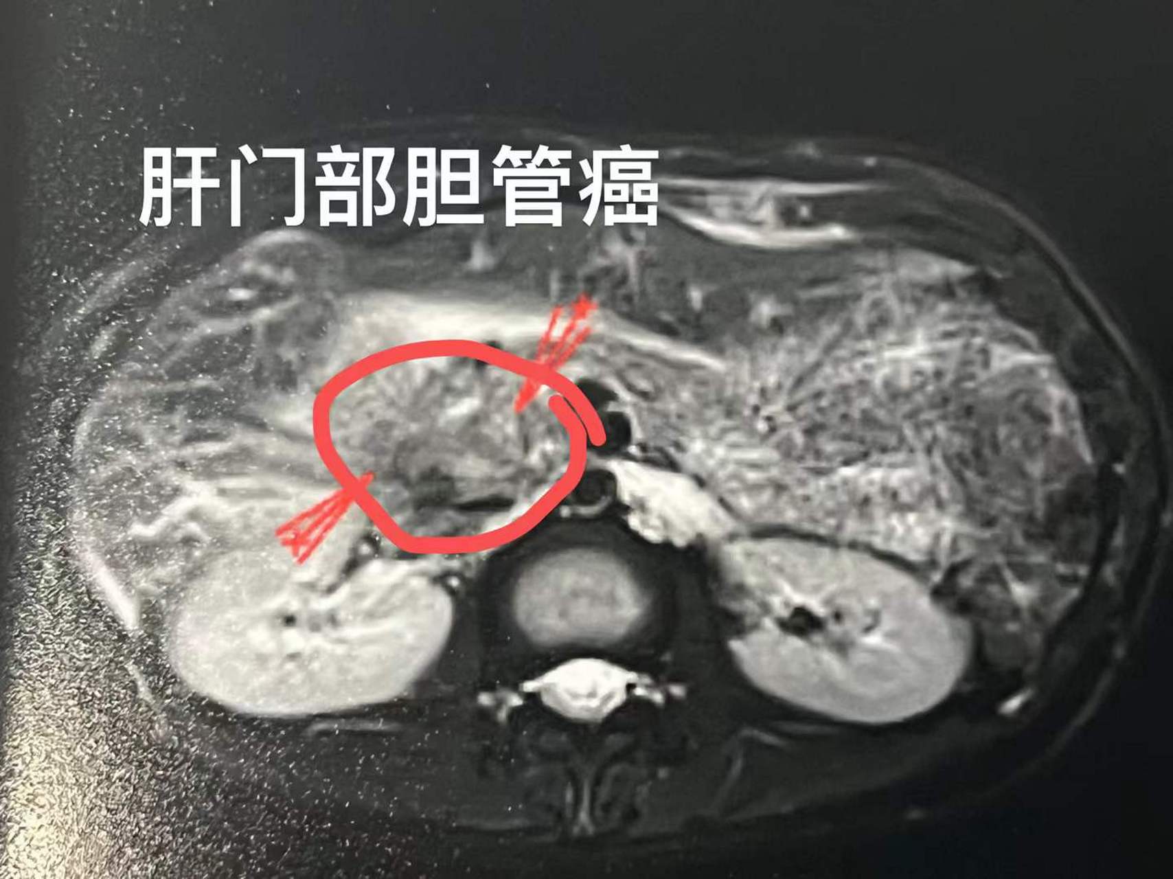 肝门部有胆管癌怎么办?