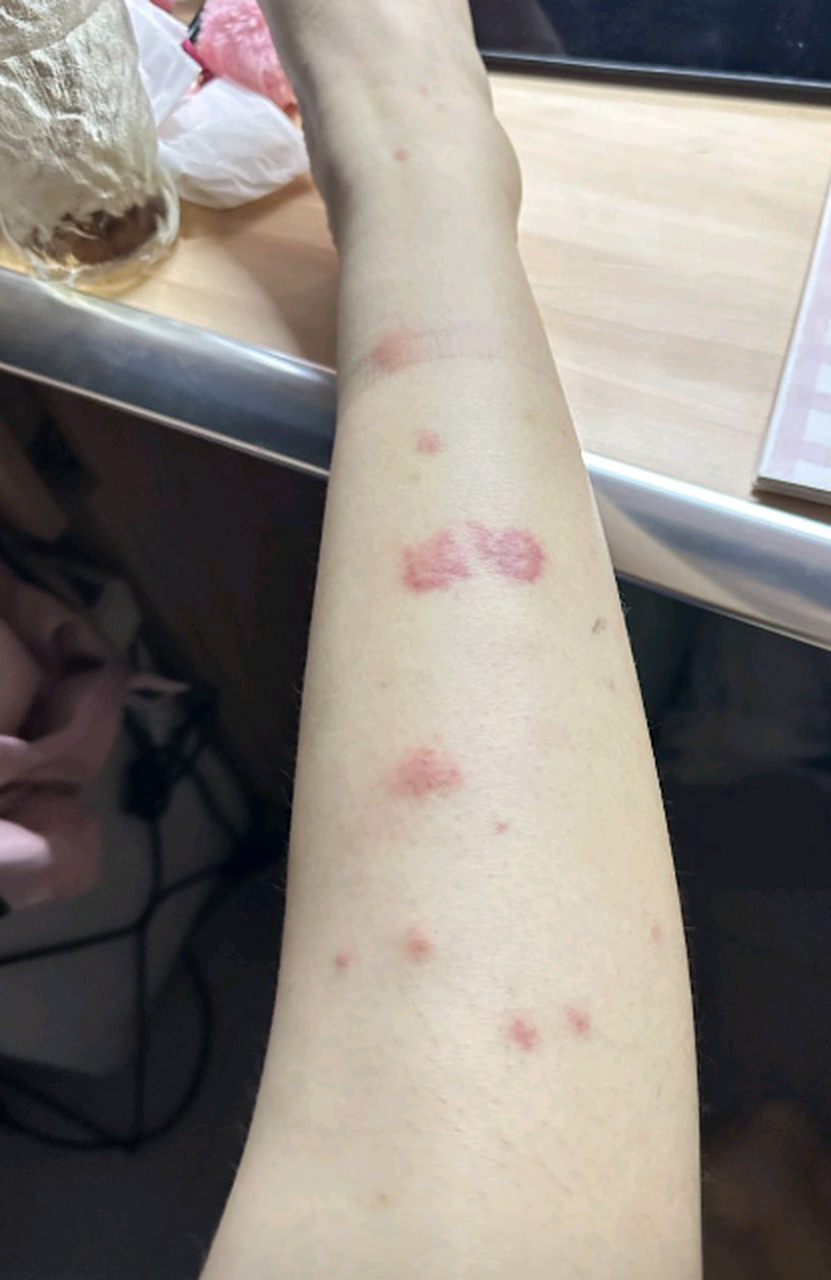 今年的蚊子这么厉害啊,腿给我咬坏了