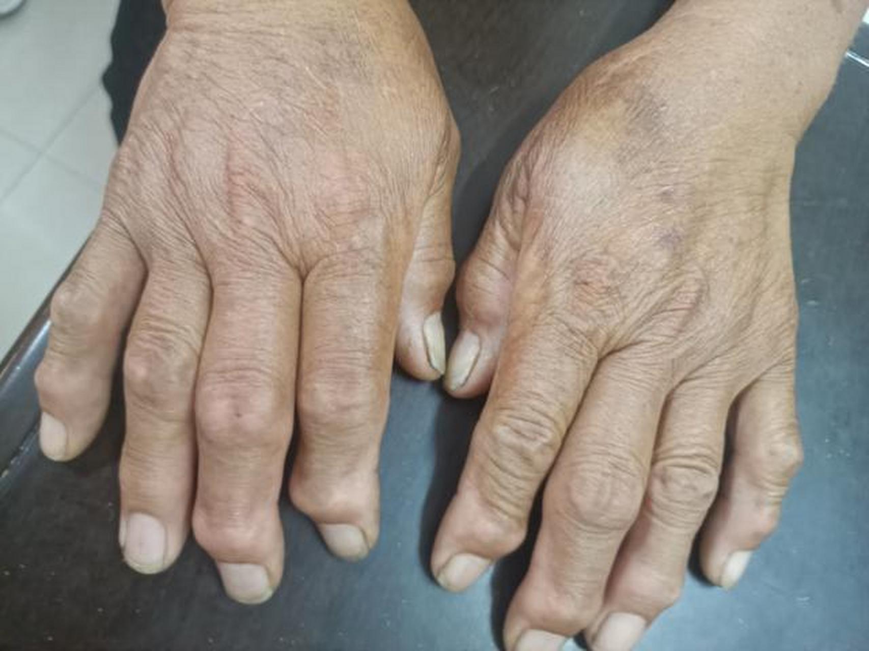 如果出现以下症状,警惕风湿疾病:  早晨起床时,感觉手脚关节僵硬,仿佛