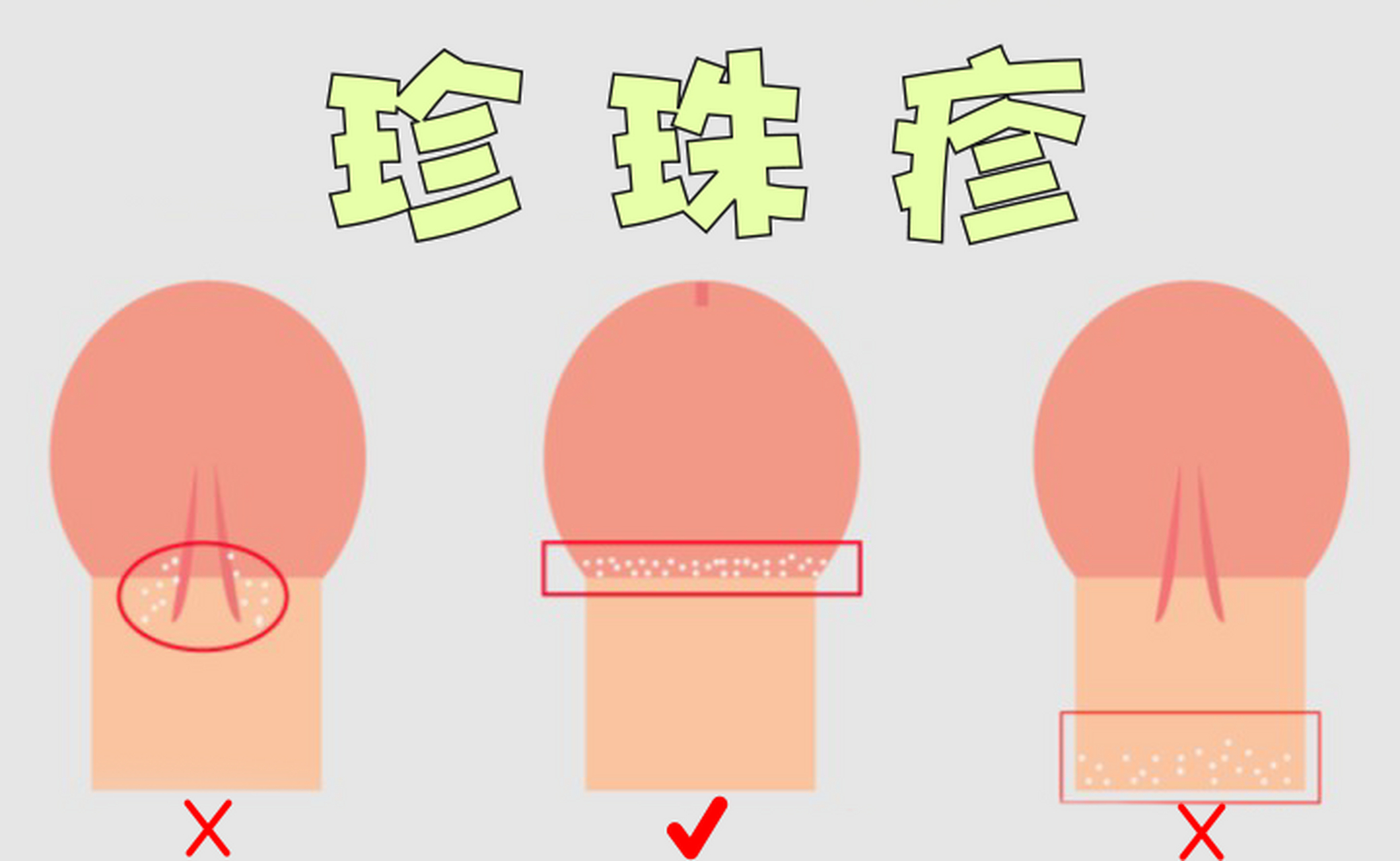 各位男同胞们,有没有发现在你们的那个"私密之处"上出现了一圈小